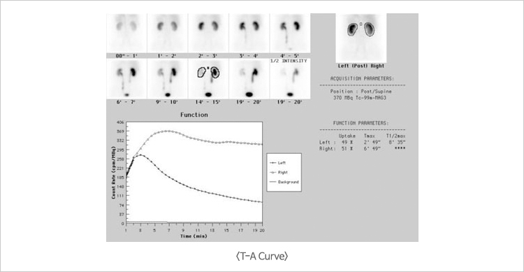 Viagra For Kidney Transplant Patients