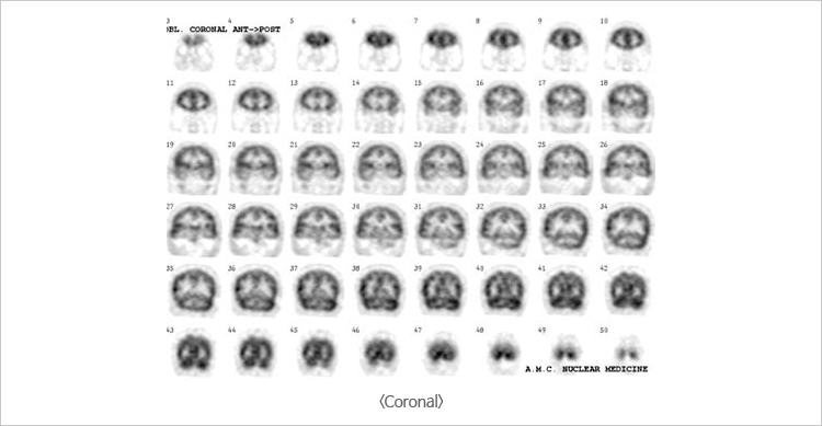 Coronal