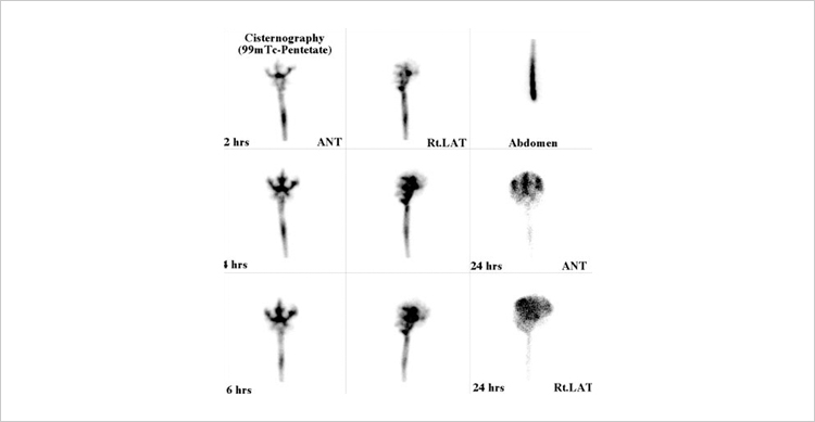 Cisternography(<sup>99m</sup>Tc-Penteate)