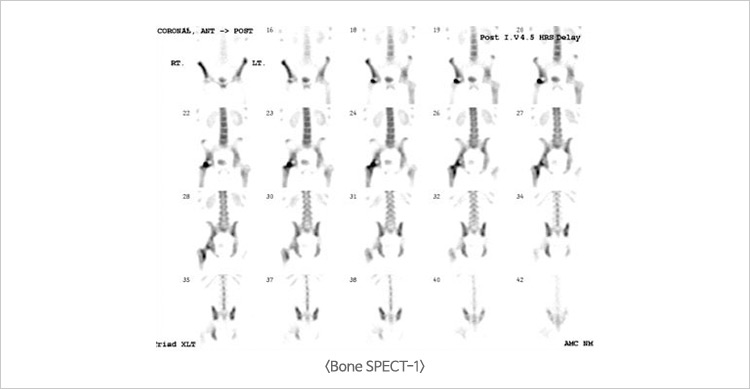 Bone SPECT-1