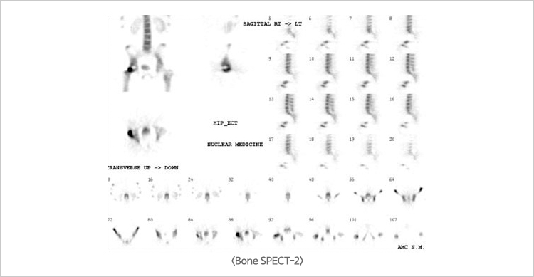 Bone SPECT-2