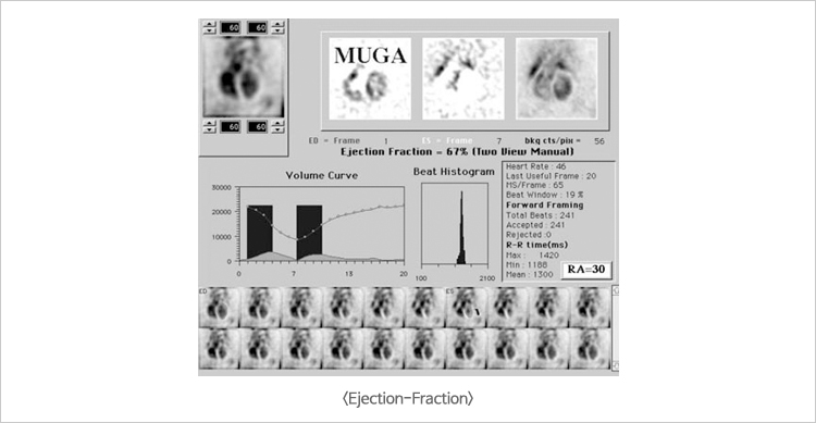 Ejection-Fraction