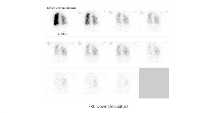 Rt. Down Decubitus