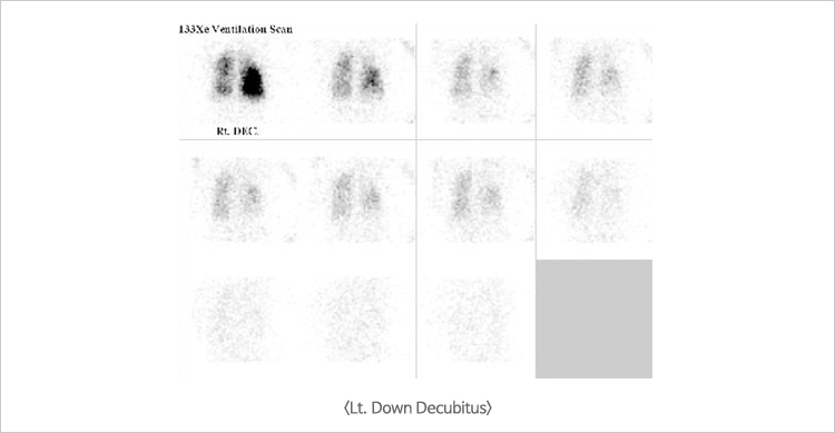Lt. Down Decubitus
