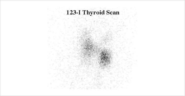 123I Thyroid Scan