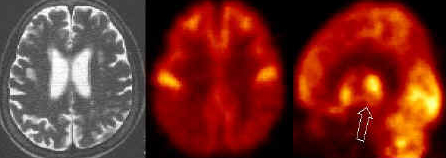 알쯔하이머병 (Alzheimer's disease)